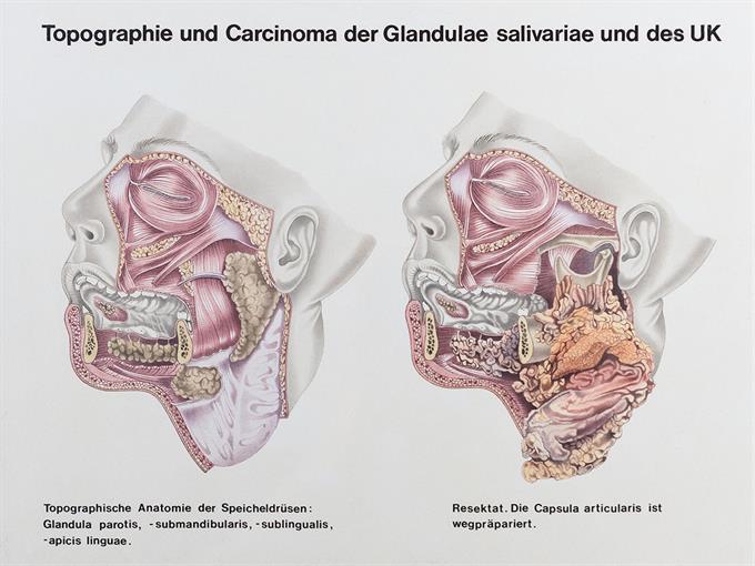 Topographie und Carcinoma der Glandulae salivariae und des UK